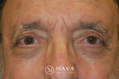 Ptosis Repair Before & After Gallery - Patient 409417 - Image 2