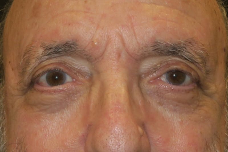 Ptosis Repair Before & After Gallery - Patient 409417 - Image 2