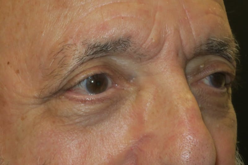 Ptosis Repair Before & After Gallery - Patient 409417 - Image 4