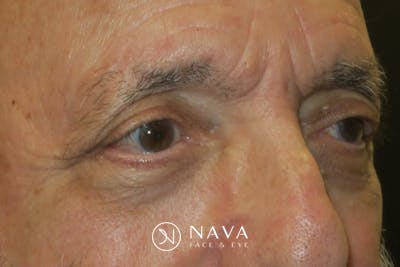 Ptosis Repair Before & After Gallery - Patient 409417 - Image 4
