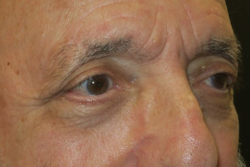Ptosis Repair Before & After Gallery - Patient 409417 - Image 4