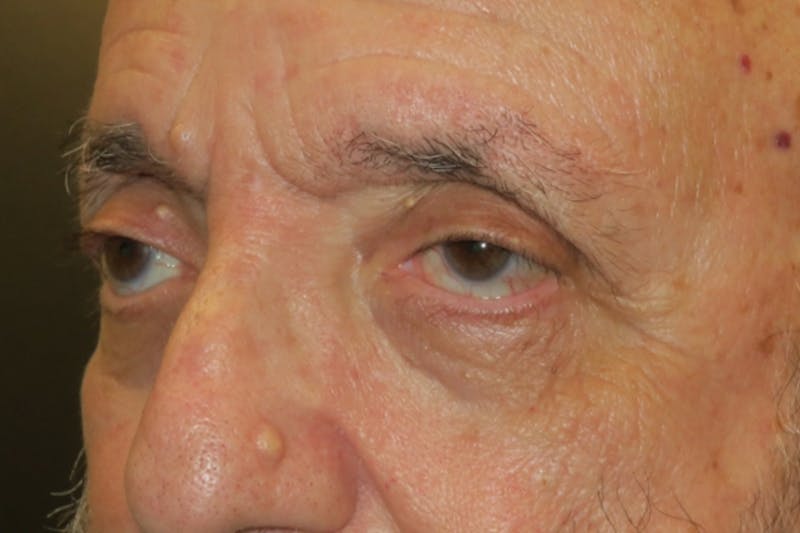 Ptosis Repair Before & After Gallery - Patient 409417 - Image 5