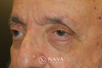 Ptosis Repair Before & After Gallery - Patient 409417 - Image 5