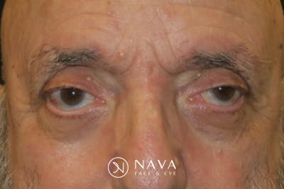 Ptosis Repair Before & After Gallery - Patient 409417 - Image 1