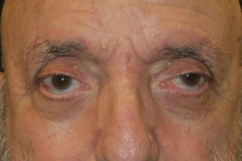 Ptosis Repair Before & After Gallery - Patient 409417 - Image 1