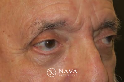 Ptosis Repair Before & After Gallery - Patient 409417 - Image 3