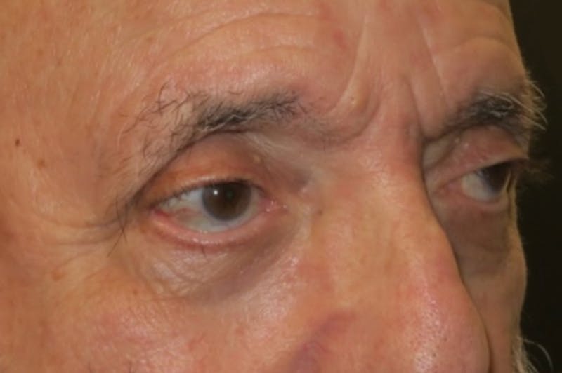 Ptosis Repair Before & After Gallery - Patient 409417 - Image 3