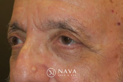 Ptosis Repair Before & After Gallery - Patient 409417 - Image 6