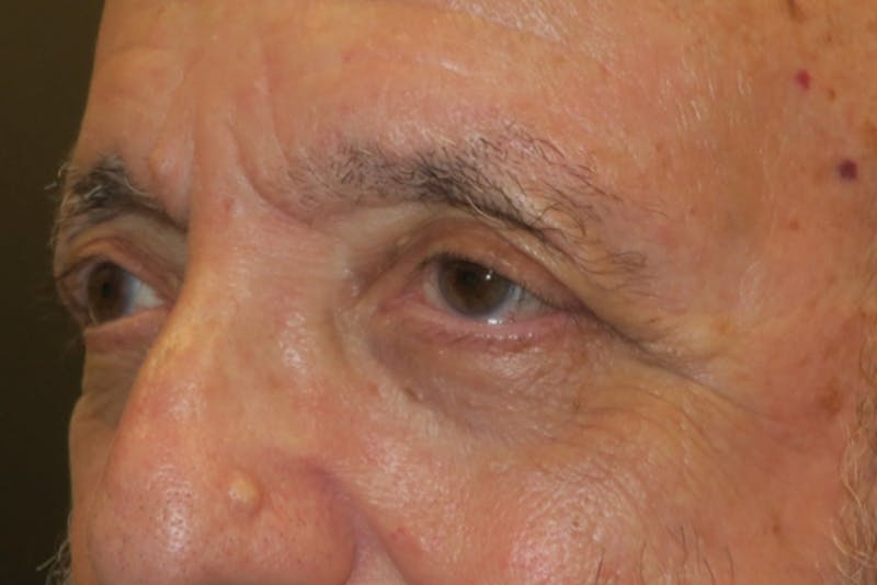 Ptosis Repair Before & After Gallery - Patient 409417 - Image 6