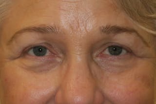 Ptosis Repair Before & After Gallery - Patient 260680 - Image 2