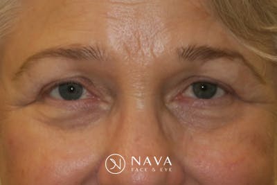 Ptosis Repair Before & After Gallery - Patient 260680 - Image 2