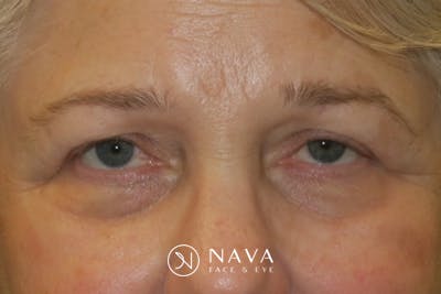 Ptosis Repair Before & After Gallery - Patient 260680 - Image 1