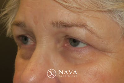 Ptosis Repair Before & After Gallery - Patient 260680 - Image 3