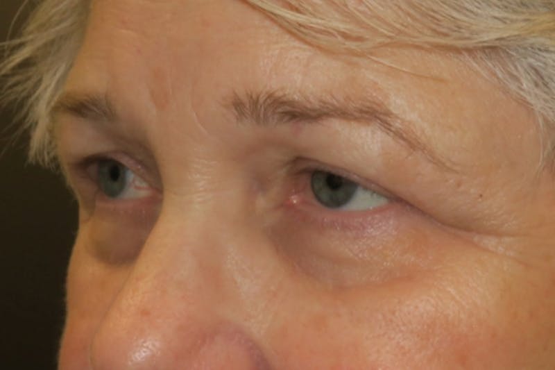 Ptosis Repair Before & After Gallery - Patient 260680 - Image 3