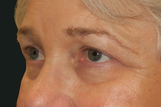 Ptosis Repair Before & After Gallery - Patient 260680 - Image 4