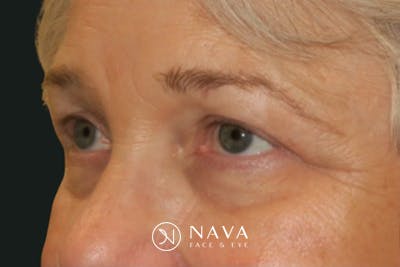 Ptosis Repair Before & After Gallery - Patient 260680 - Image 4