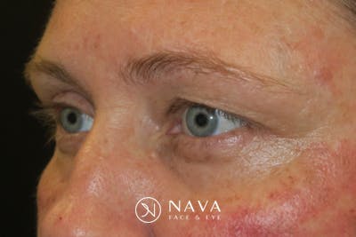 Upper Blepharoplasty (Upper Eyelid Surgery) Before & After Gallery - Patient 108018 - Image 5