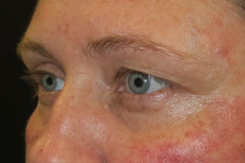 Upper Blepharoplasty (Upper Eyelid Surgery) Before & After Gallery - Patient 108018 - Image 5