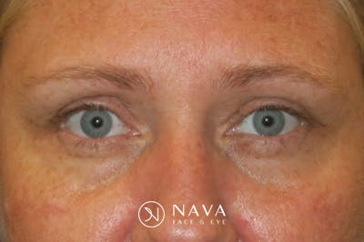 Upper Blepharoplasty (Upper Eyelid Surgery) Before & After Gallery - Patient 108018 - Image 2