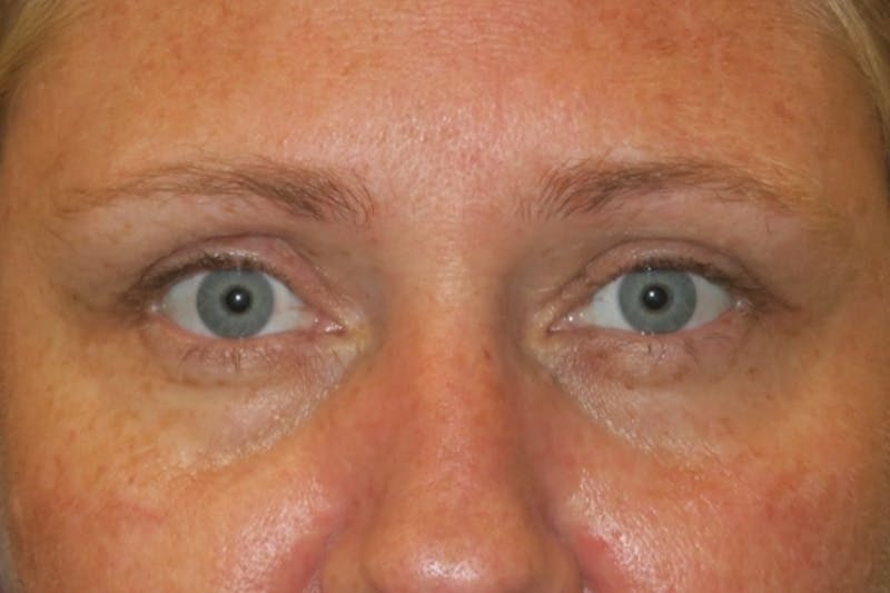 Upper Blepharoplasty (Upper Eyelid Surgery) Before & After Gallery - Patient 108018 - Image 2