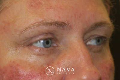 Upper Blepharoplasty (Upper Eyelid Surgery) Before & After Gallery - Patient 108018 - Image 3