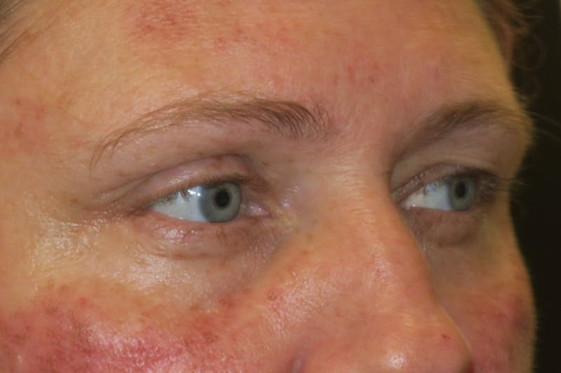 Upper Blepharoplasty (Upper Eyelid Surgery) Before & After Gallery - Patient 108018 - Image 3