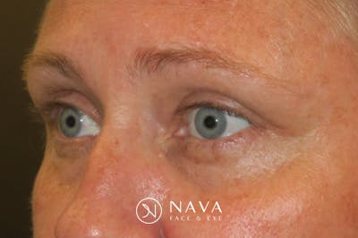 Upper Blepharoplasty (Upper Eyelid Surgery) Before & After Gallery - Patient 108018 - Image 6
