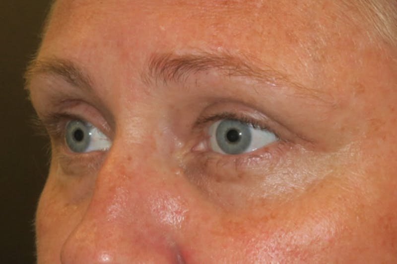 Upper Blepharoplasty (Upper Eyelid Surgery) Before & After Gallery - Patient 108018 - Image 6