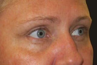 Upper Blepharoplasty (Upper Eyelid Surgery) Before & After Gallery - Patient 108018 - Image 4