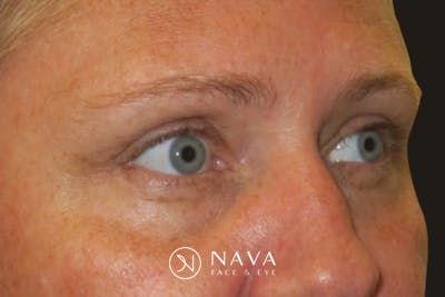 Upper Blepharoplasty (Upper Eyelid Surgery) Before & After Gallery - Patient 108018 - Image 4