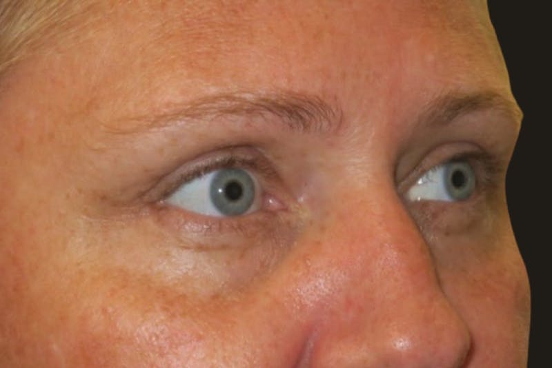 Upper Blepharoplasty (Upper Eyelid Surgery) Before & After Gallery - Patient 108018 - Image 4