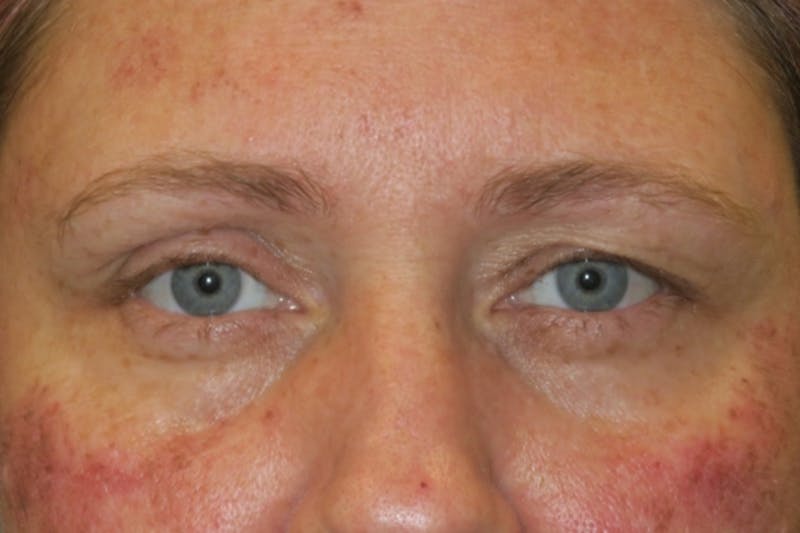 Browplasty (Brow Lift) Before & After Gallery - Patient 131323 - Image 1