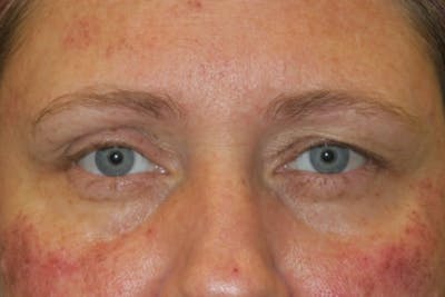 Upper Blepharoplasty (Upper Eyelid Surgery) Before & After Gallery - Patient 108018 - Image 1