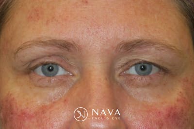 Upper Blepharoplasty (Upper Eyelid Surgery) Before & After Gallery - Patient 108018 - Image 1