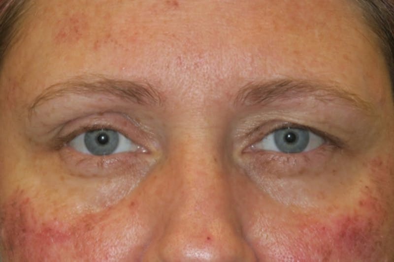 Upper Blepharoplasty (Upper Eyelid Surgery) Before & After Gallery - Patient 108018 - Image 1