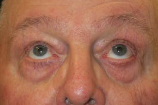 Mohs Reconstruction Before & After Gallery - Patient 376364 - Image 6