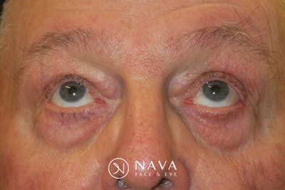 Mohs Reconstruction Before & After Gallery - Patient 376364 - Image 6