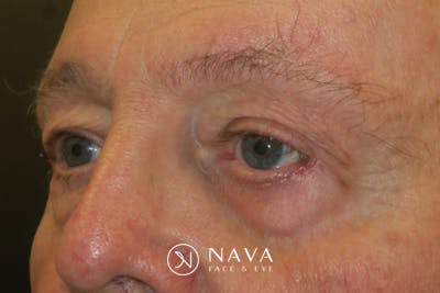 Mohs Reconstruction Before & After Gallery - Patient 376364 - Image 4