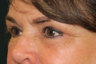 Ptosis Repair Before & After Gallery - Patient 424221 - Image 6