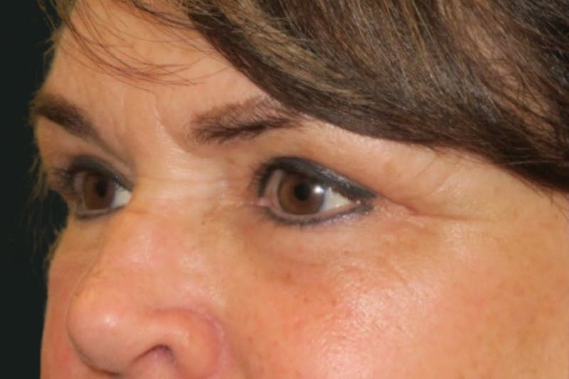 Ptosis Repair Before & After Gallery - Patient 424221 - Image 6