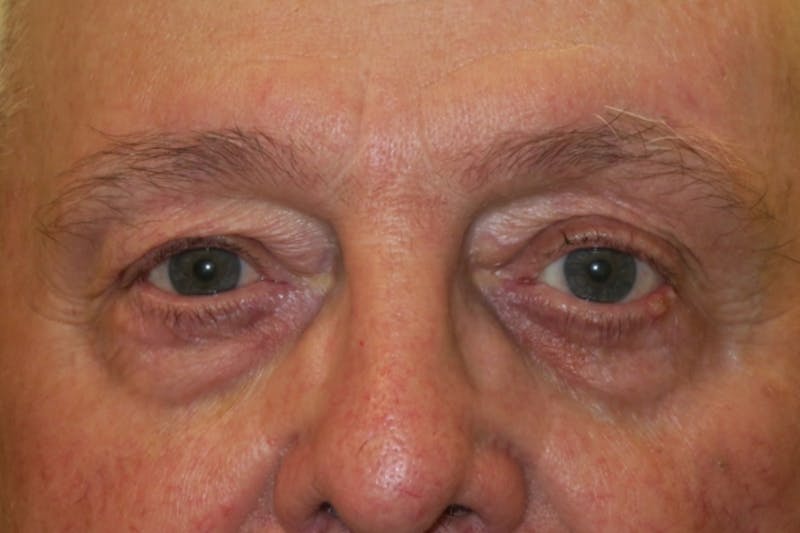 Mohs Reconstruction Before & After Gallery - Patient 404593 - Image 1