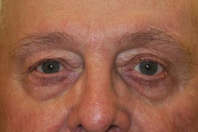 Mohs Reconstruction Before & After Gallery - Patient 376364 - Image 1