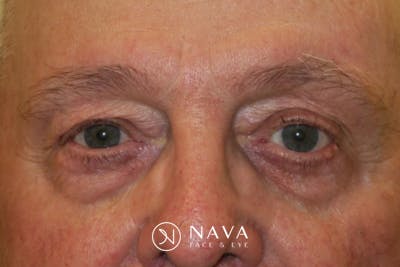 Mohs Reconstruction Before & After Gallery - Patient 376364 - Image 1