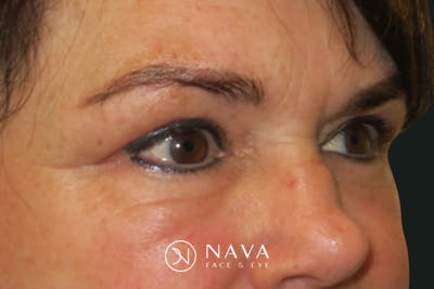 Ptosis Repair Before & After Gallery - Patient 424221 - Image 4