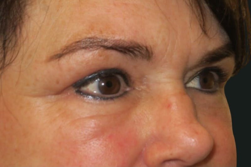 Ptosis Repair Before & After Gallery - Patient 424221 - Image 4