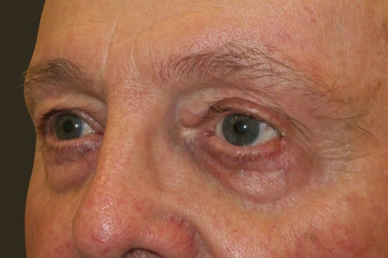 Mohs Reconstruction Before & After Gallery - Patient 404593 - Image 3