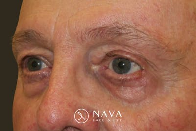 Mohs Reconstruction Before & After Gallery - Patient 376364 - Image 3