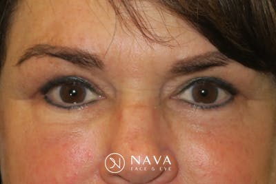 Ptosis Repair Before & After Gallery - Patient 424221 - Image 2