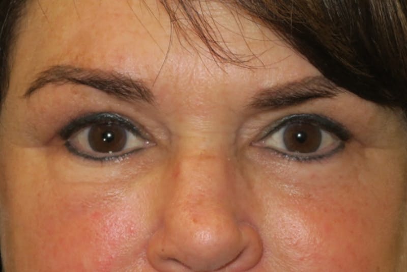 Ptosis Repair Before & After Gallery - Patient 424221 - Image 2