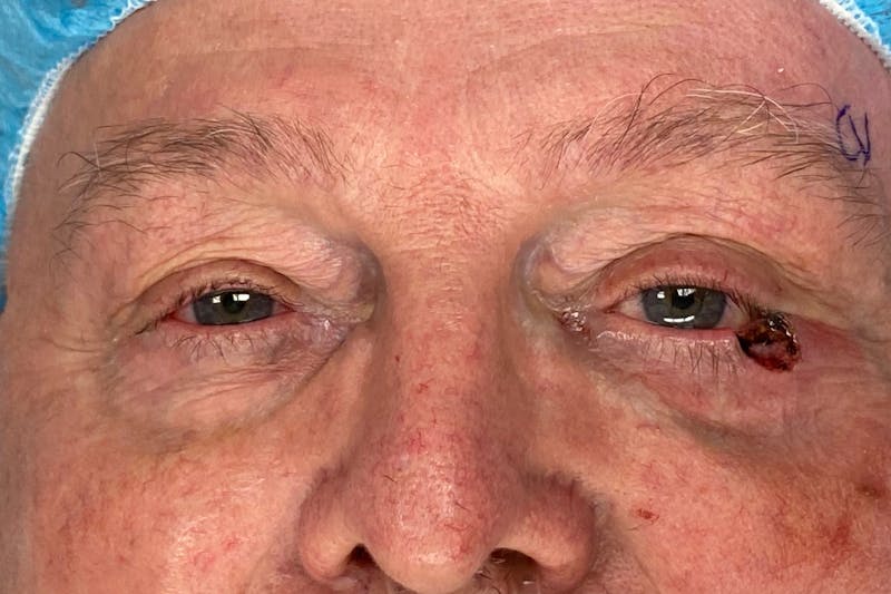 Mohs Reconstruction Before & After Gallery - Patient 404593 - Image 5